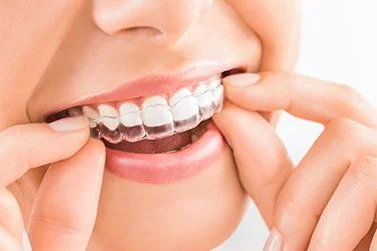 A patient placing clear Invisalign aligners