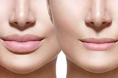 Before and after lips with JUVÉDERM®